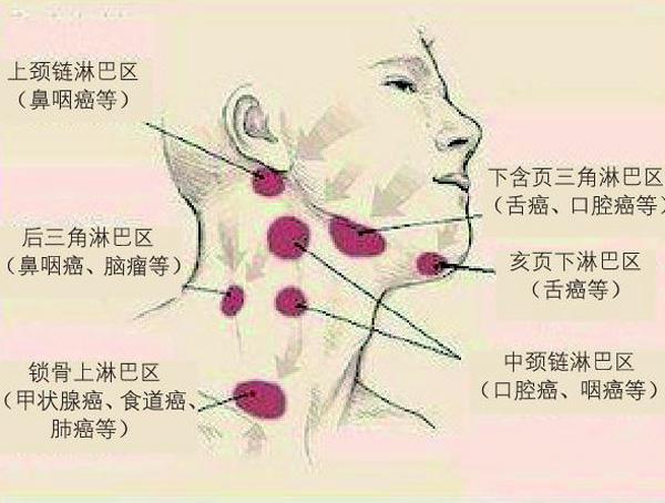 但患者除发热和血栓形成外,起病近5月仍无脏器受累的证据,浅表淋巴结