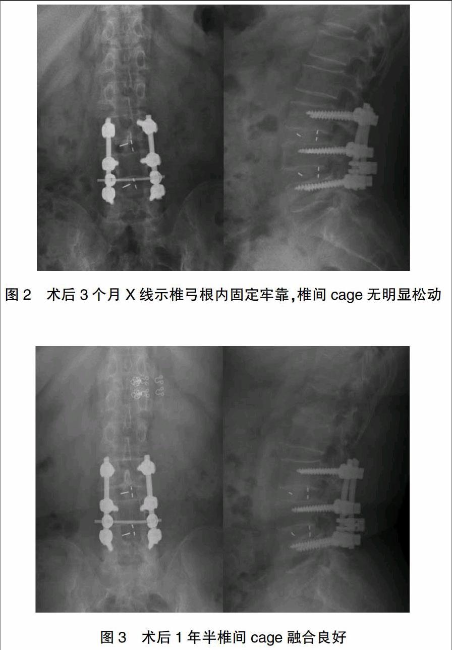 应用受累节段广泛椎板减压,椎弓根钉系统内固定,椎间cage植入融合的