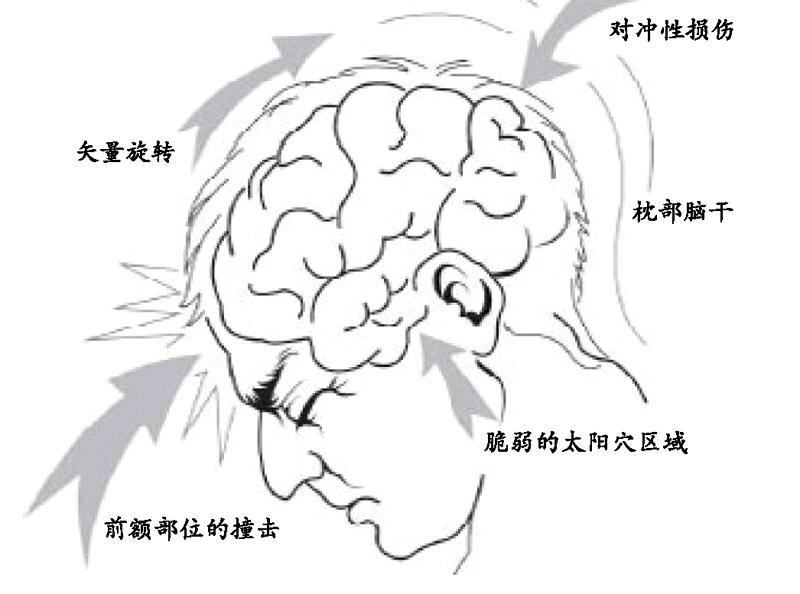 脑出血:包括任何脑内出血,比如脑损伤后出血或因高血压而导致脑卒中.