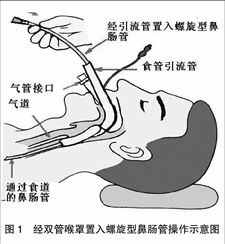 通过双管喉罩留置螺旋型鼻肠管的临床研究