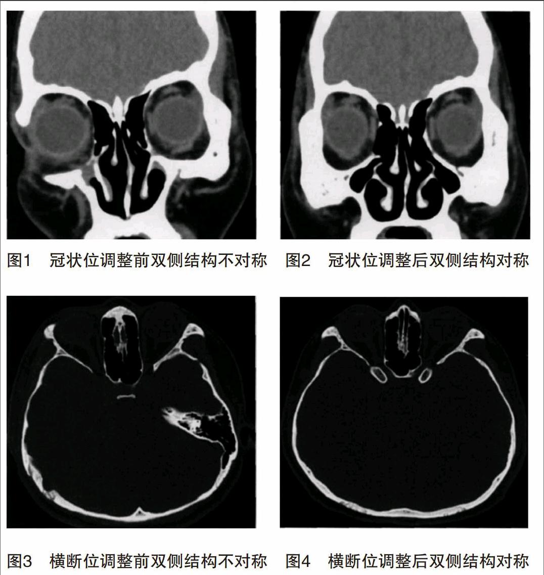 多层螺旋ct后处理技术在眼眶正常相关结构诊断中的应用价值