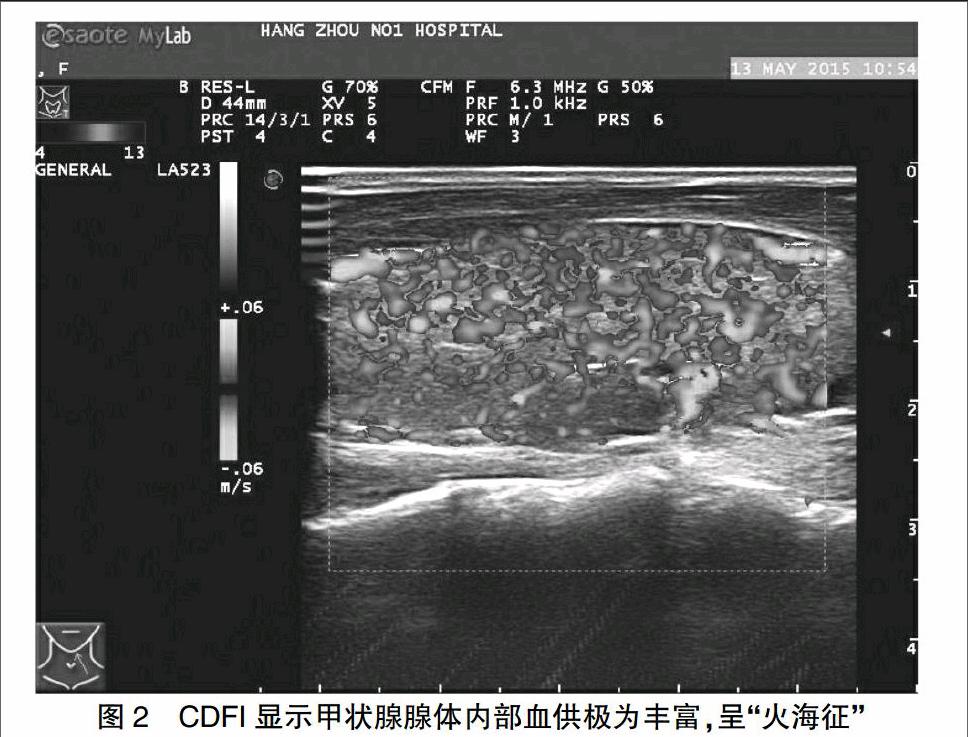 超声弹性成像与常规超声对桥本氏甲状腺炎及graves病的鉴别诊断价值