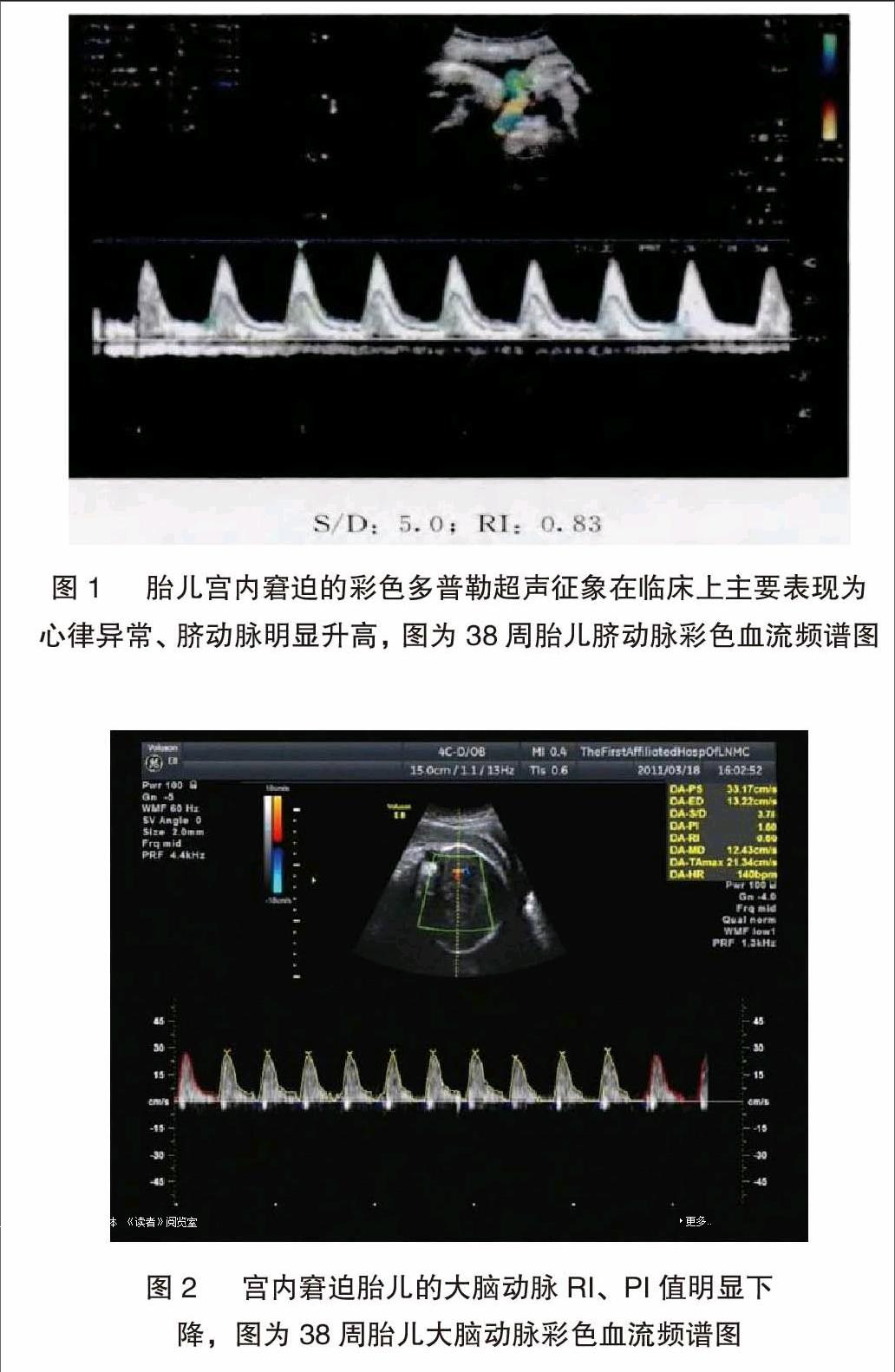 通过对其胎儿心率,脐动脉收缩期峰流速以及舒张末期流