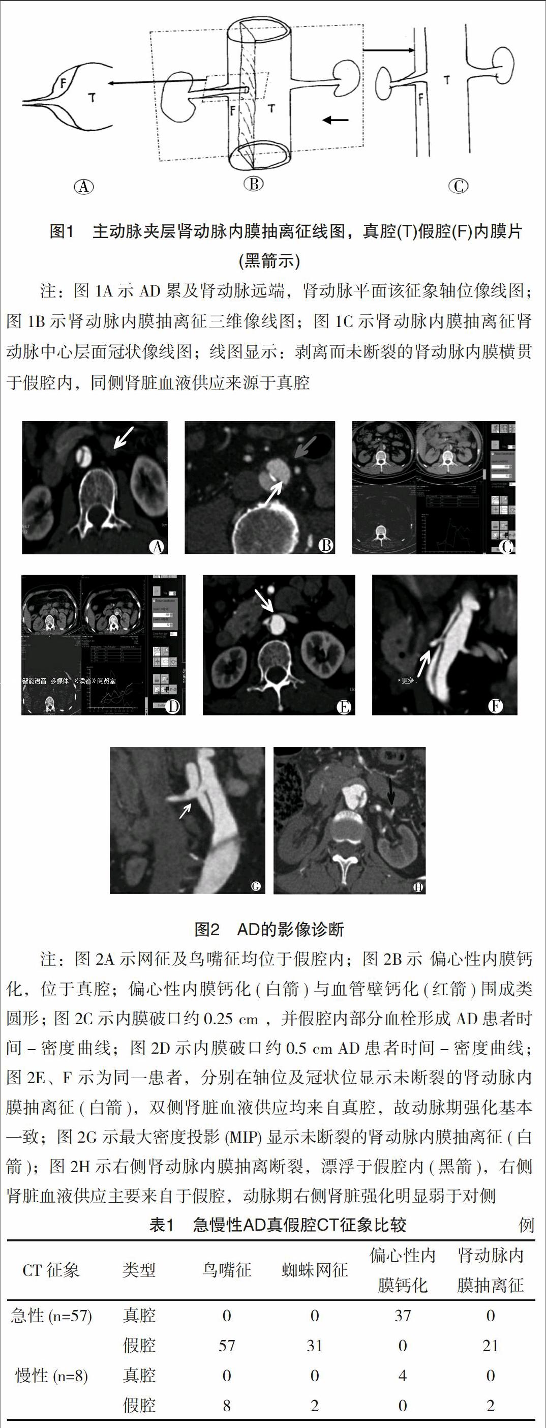 肾动脉内膜抽离征区分Ⅰ,Ⅲ型主动脉夹层真假腔的临床