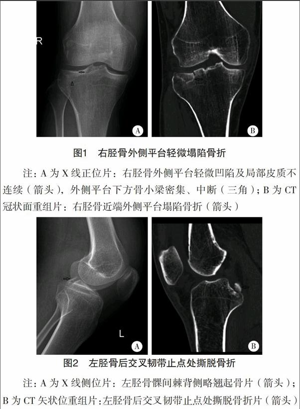 膝关节可疑骨折的x线平片与ct对比分析
