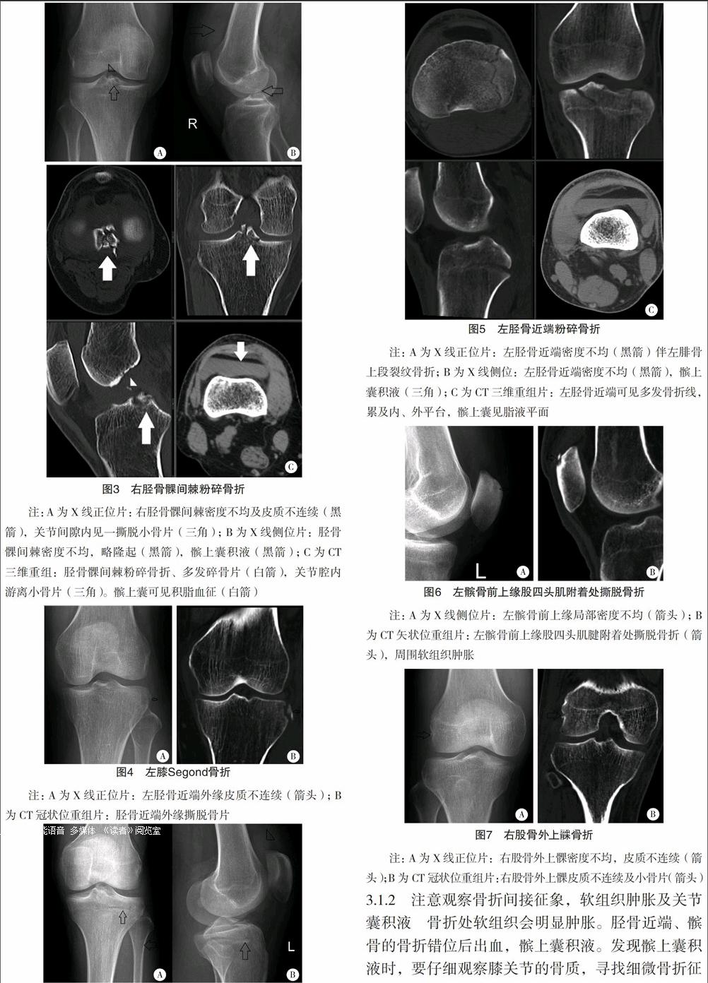 膝关节可疑骨折的x线平片与ct对比分析