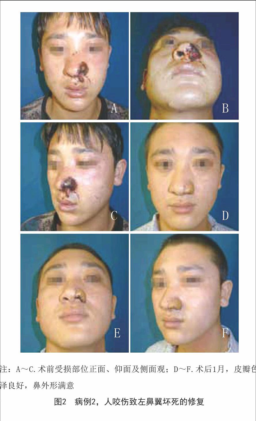 所有患者的移植皮瓣完全成活,皮瓣色泽,质地与面部皮肤接近,鼻外形