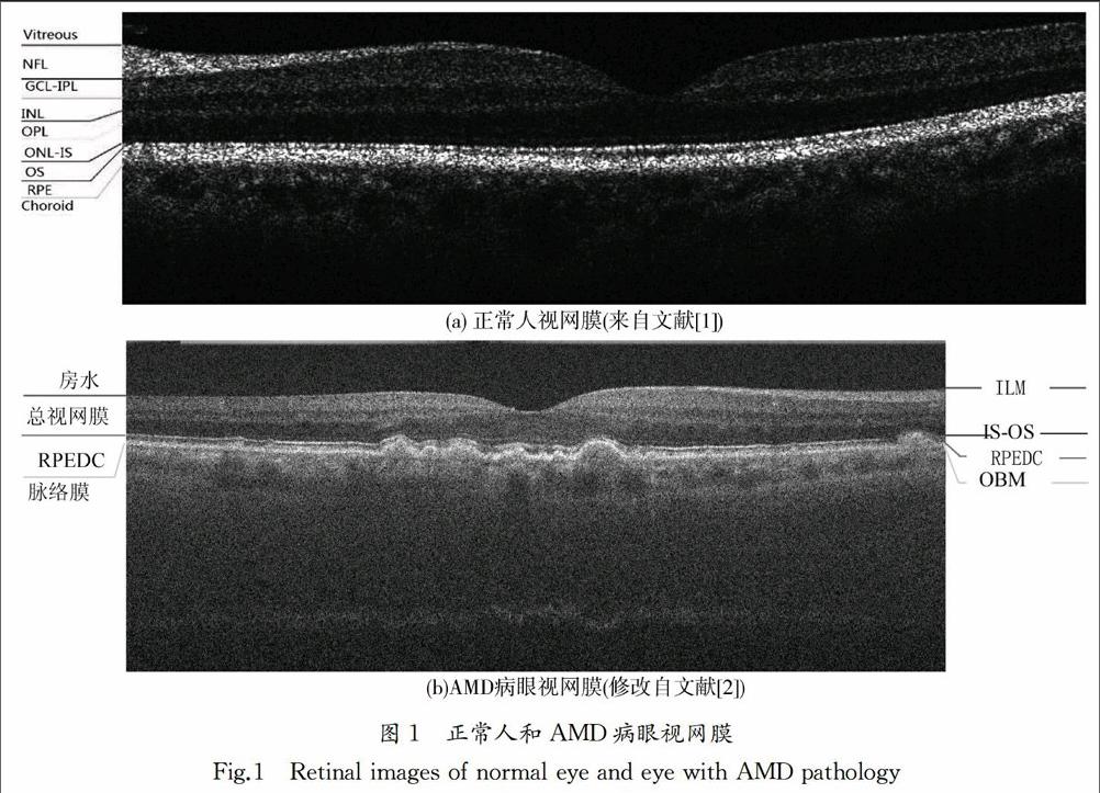 老年黄斑变性频域光学相干断层图像分割研究