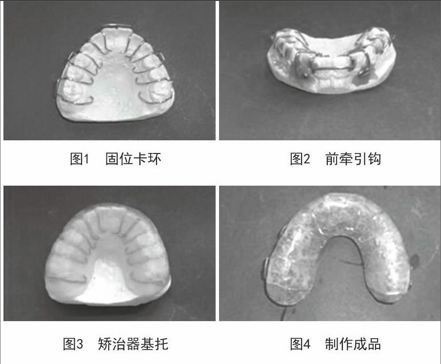 一种矫治替牙期骨Ⅲ类上颌卡环式(牙 合)垫前牵引矫治