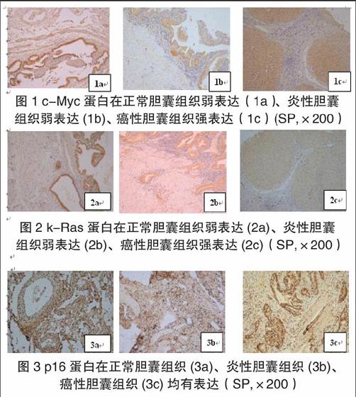 方法:收集20例胆囊癌,50例慢性胆囊炎和20例正常胆囊组织标本,用免疫