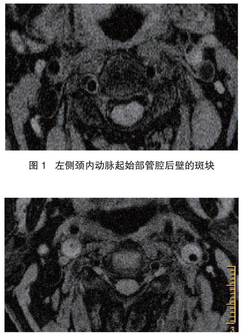 颈动脉粥样斑块的mri诊断价值