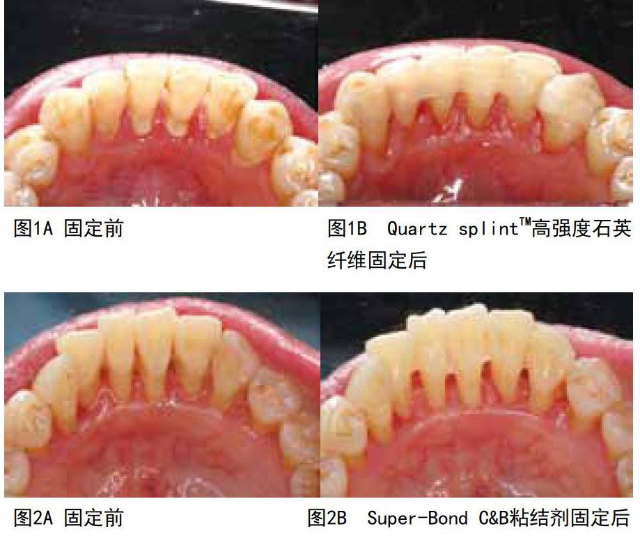 quartz splinttm高强度石英纤维和super—bond c&b粘结剂固定下前牙