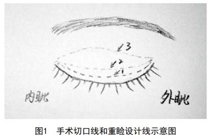 切口两种重睑成形术同期行stallard法"z"形皮瓣修复内眦赘皮的临床