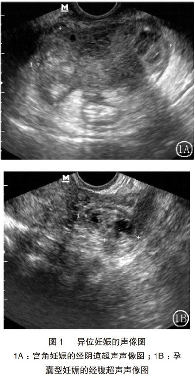 经腹和经阴道超声诊断早期异位妊娠的临床价值分析