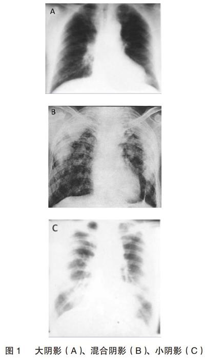 尘肺合并肺结核患者x线诊断及鉴别诊断