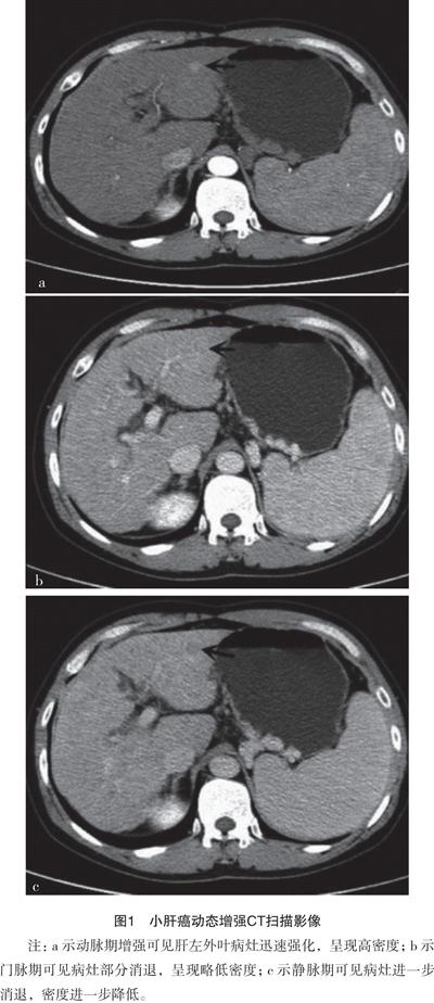 动态增强ct扫描小肝癌的影像学特点及定性诊断价值