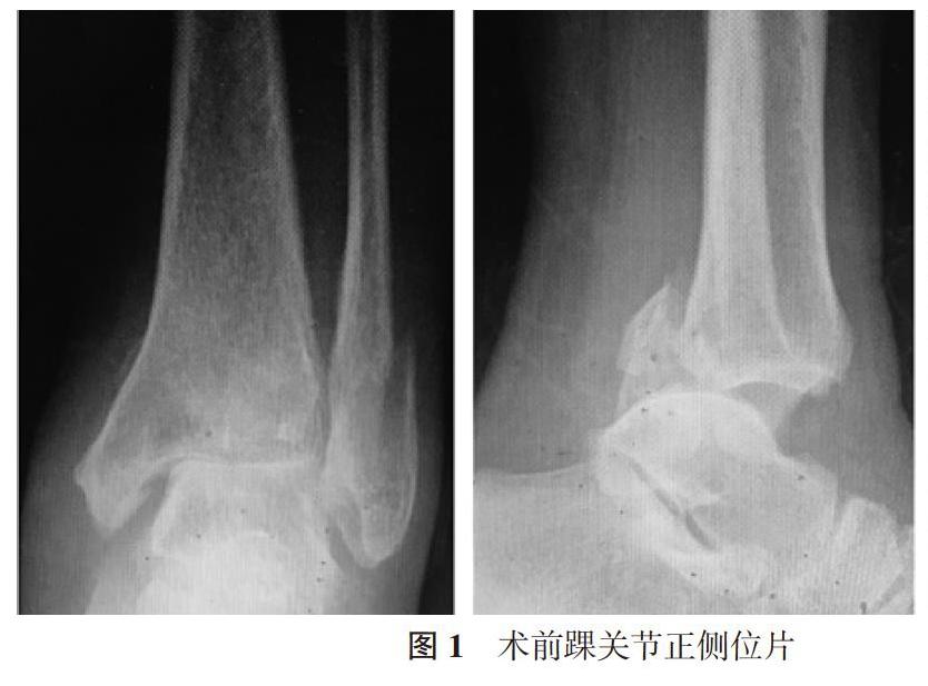 后外侧,后内侧入路手术治疗三踝骨折伴踝关节脱位的临床疗效分析