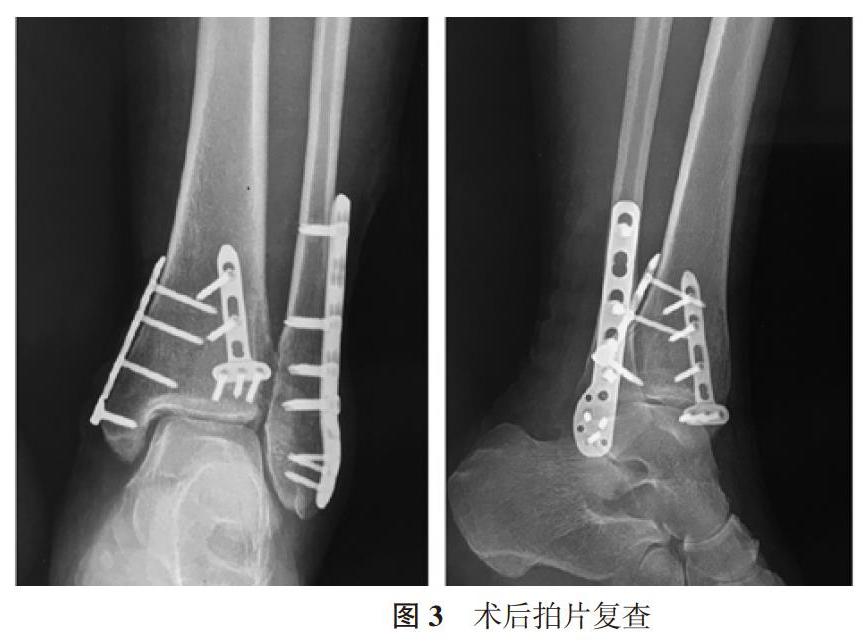 后外侧,后内侧入路手术治疗三踝骨折伴踝关节脱位的临床疗效分析