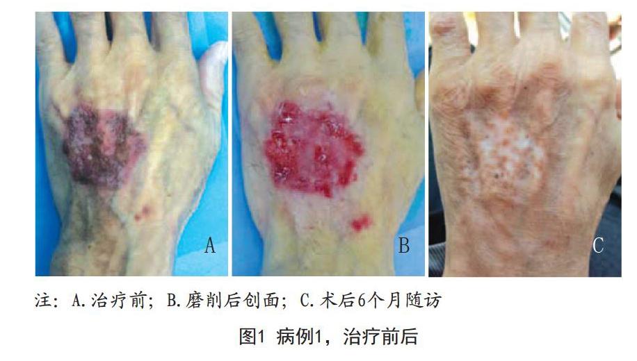 机械磨削术联合氨基酮戊酸光动力疗法治疗手部bowen病