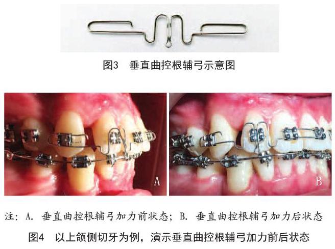 控根辅弓在标准方丝弓矫治的牙列排齐整平阶段实现对牙齿转矩的有效