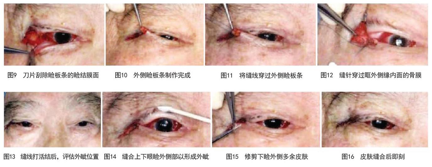 外侧睑板条固定术联合射频技术矫正退行性下睑外翻