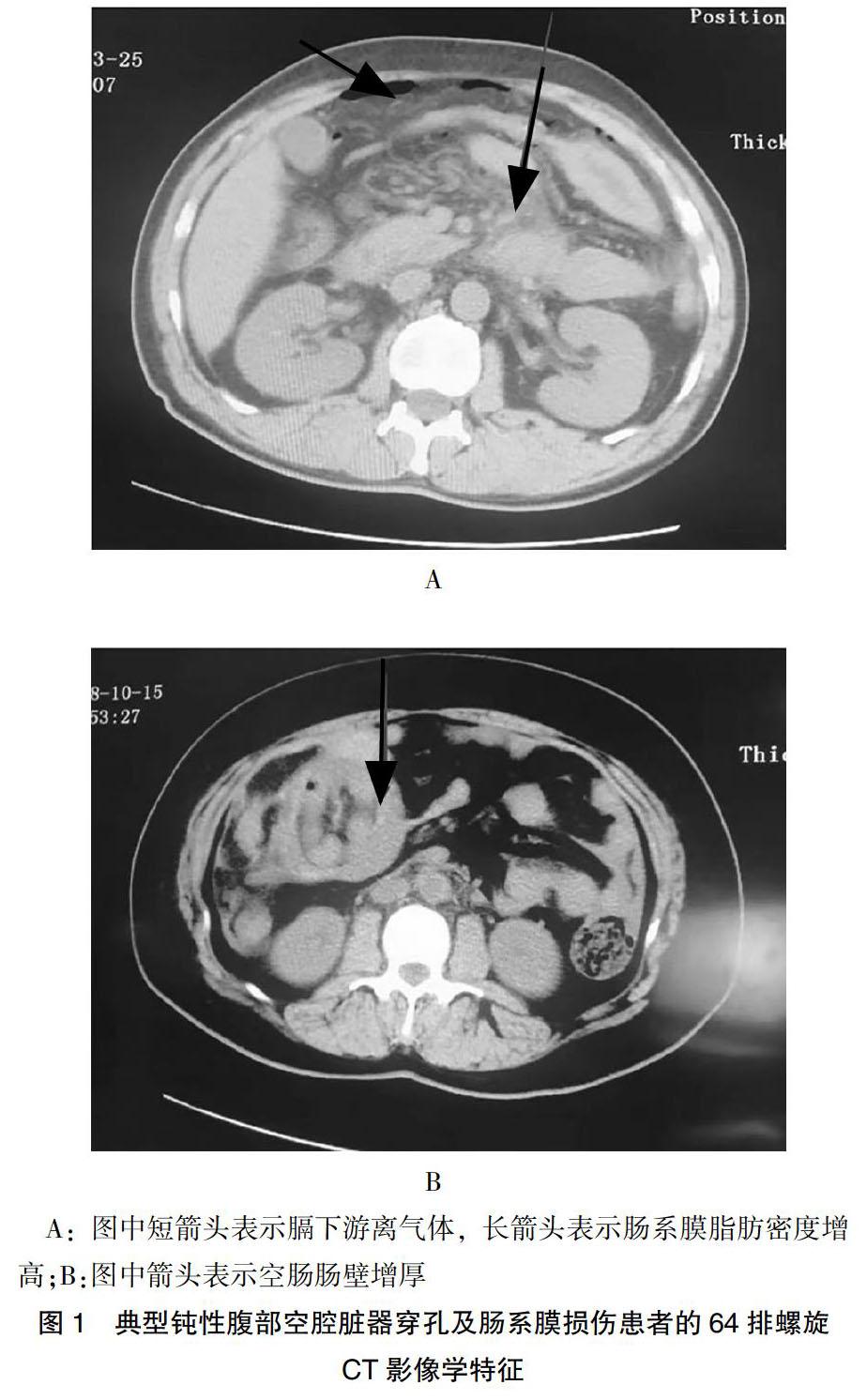 钝性腹部空腔脏器穿孔及肠系膜损伤患者的64排螺旋ct影像学指征及特点