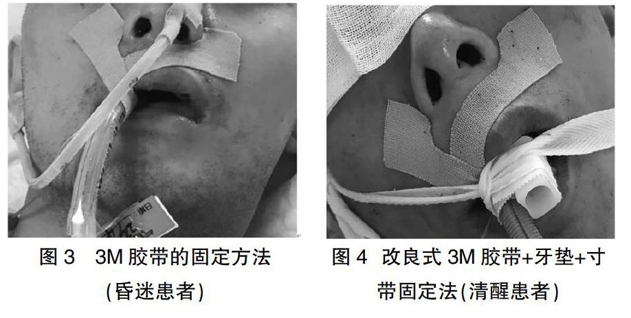 改良式3m弹力胶带固定法在重症监护病房经口气管插管患者中的应用效果