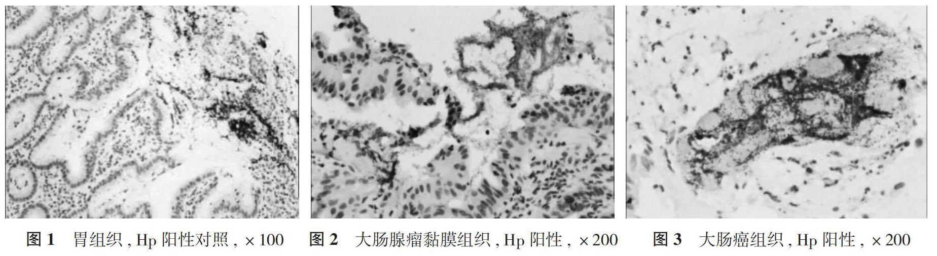 不同大肠黏膜组织hp,cyclind1,p16免疫组化表达分析