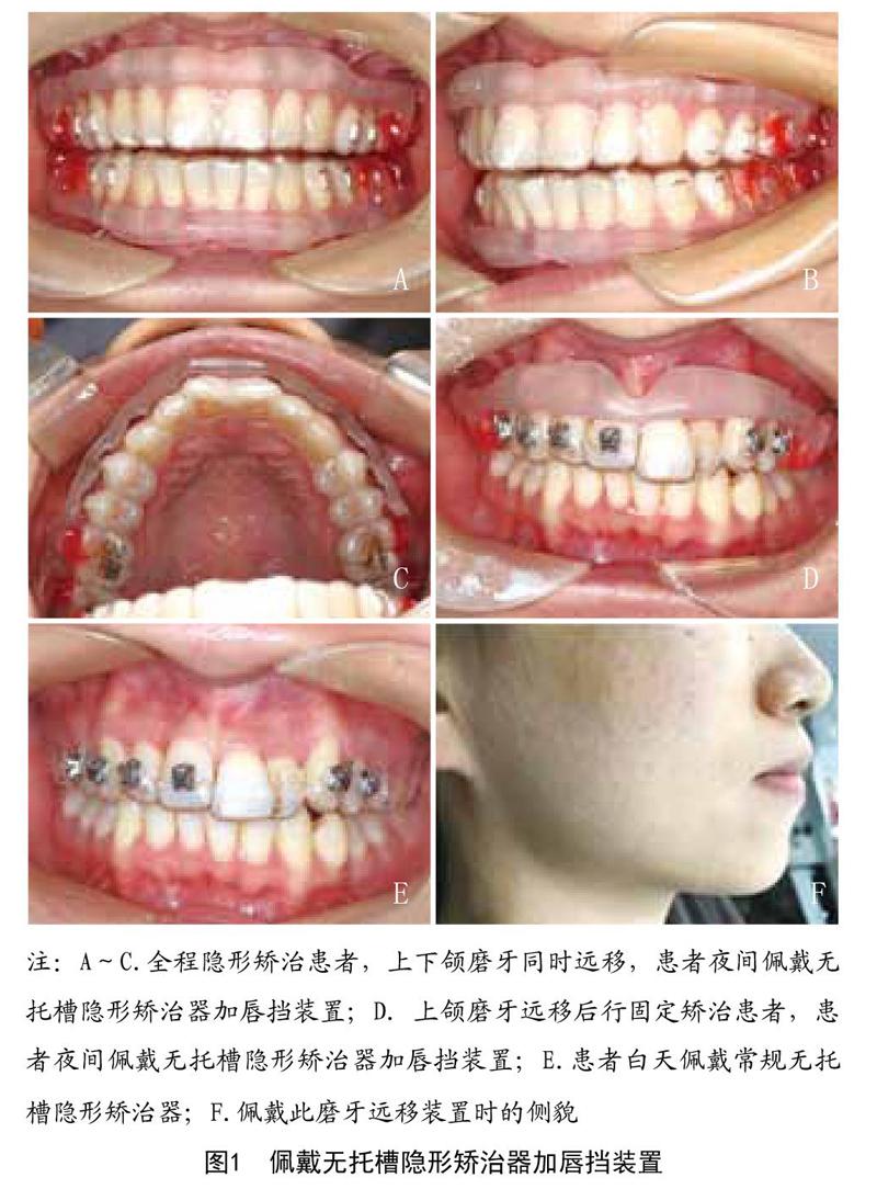 [关键词]无托槽隐形矫治技术;磨牙远移;唇挡大多数