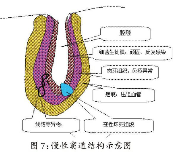 胆道t管窦道形成图图片