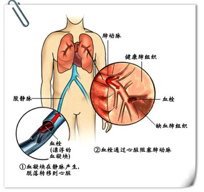 包括呼吸困難,呼吸加快,胸膜性疼痛,焦慮,心動過速,咳嗽,咳血,暈厥