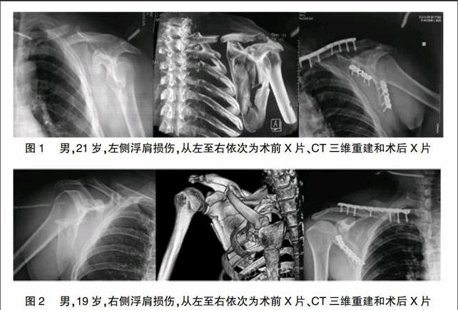 鎖骨骨折,肩鎖關節脫位合併同側肩甲頸骨折的治療