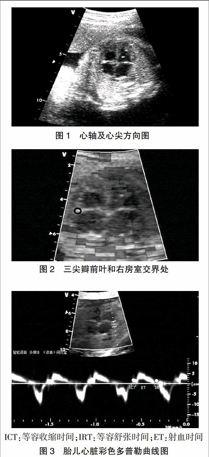 tei指数在重度子痫前期胎儿右心功能评价中的应用