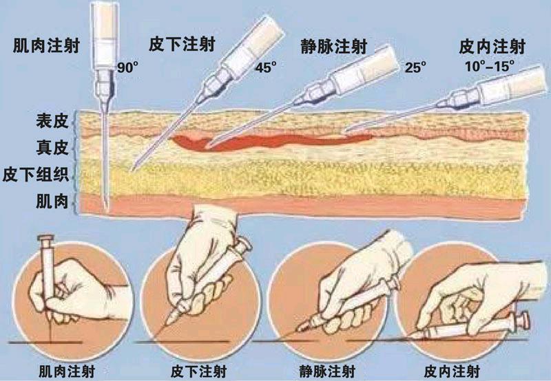 肌内注射缩写图片