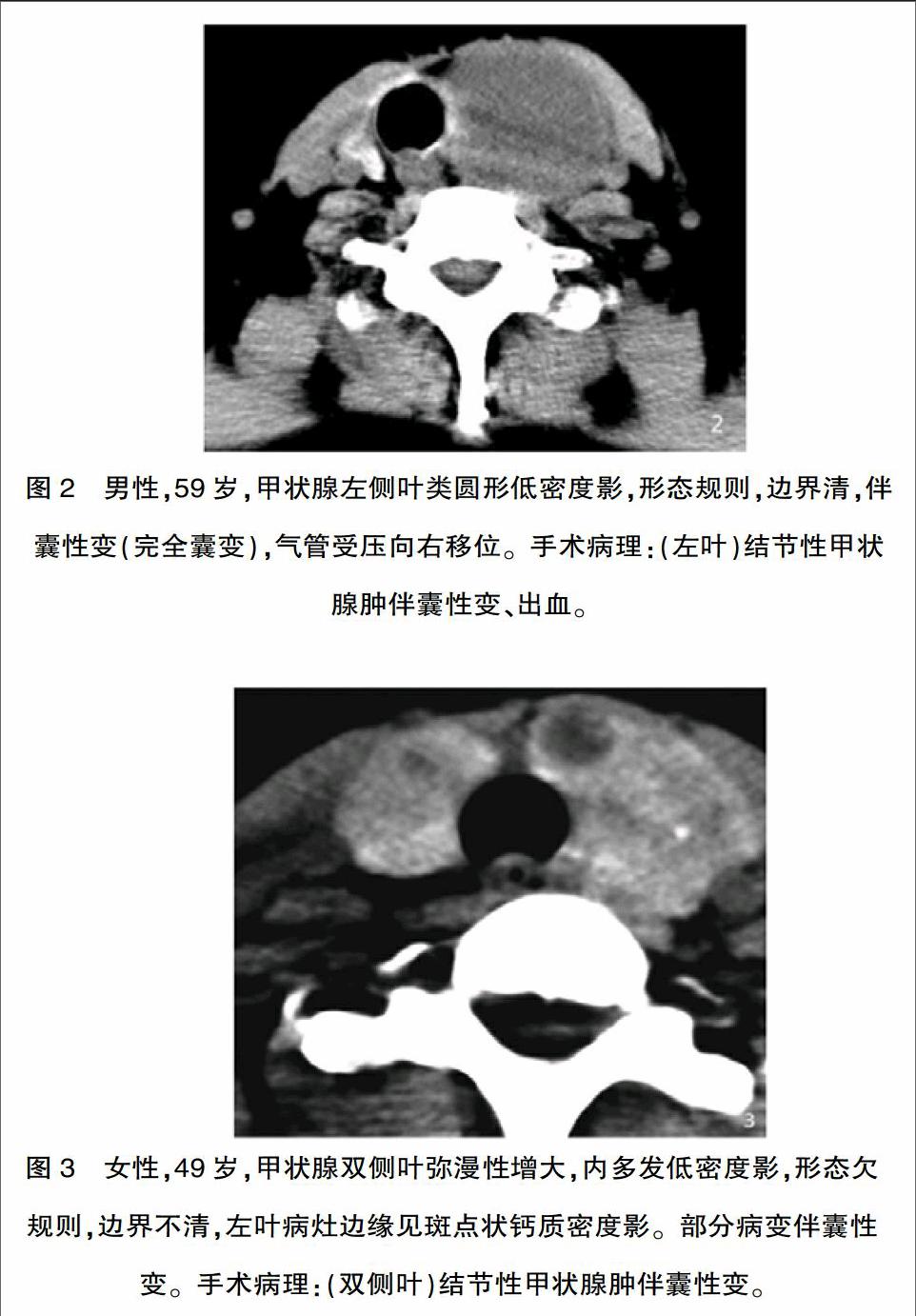 甲状腺ct平扫定位图图片