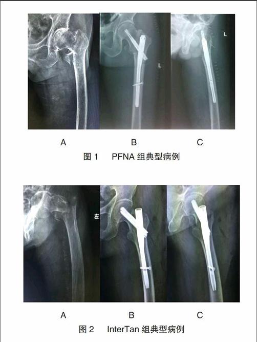 pfna與intertan內固定系統治療股骨轉子間骨折療效比較研究