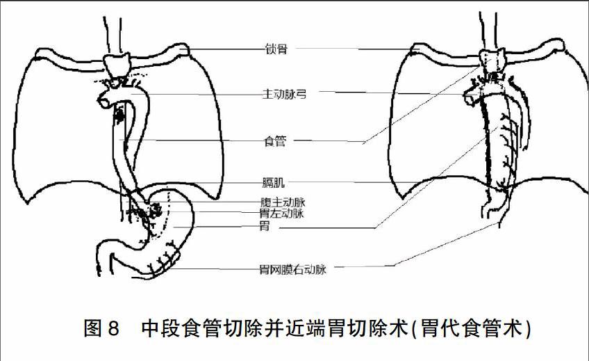 食管,胃双源癌外科治疗的研究进展