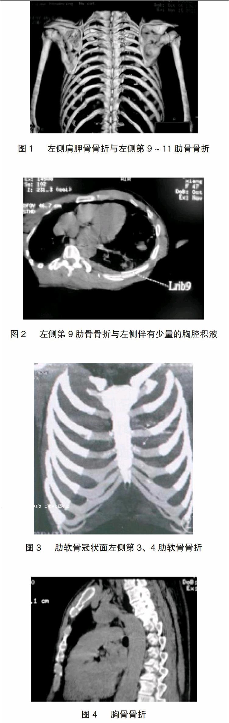 多层螺旋ct三维重建技术在胸部外伤的诊断价值 参考网