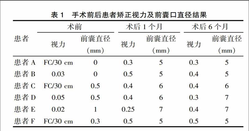 严重前囊膜浑浊的新式手术方法疗效分析