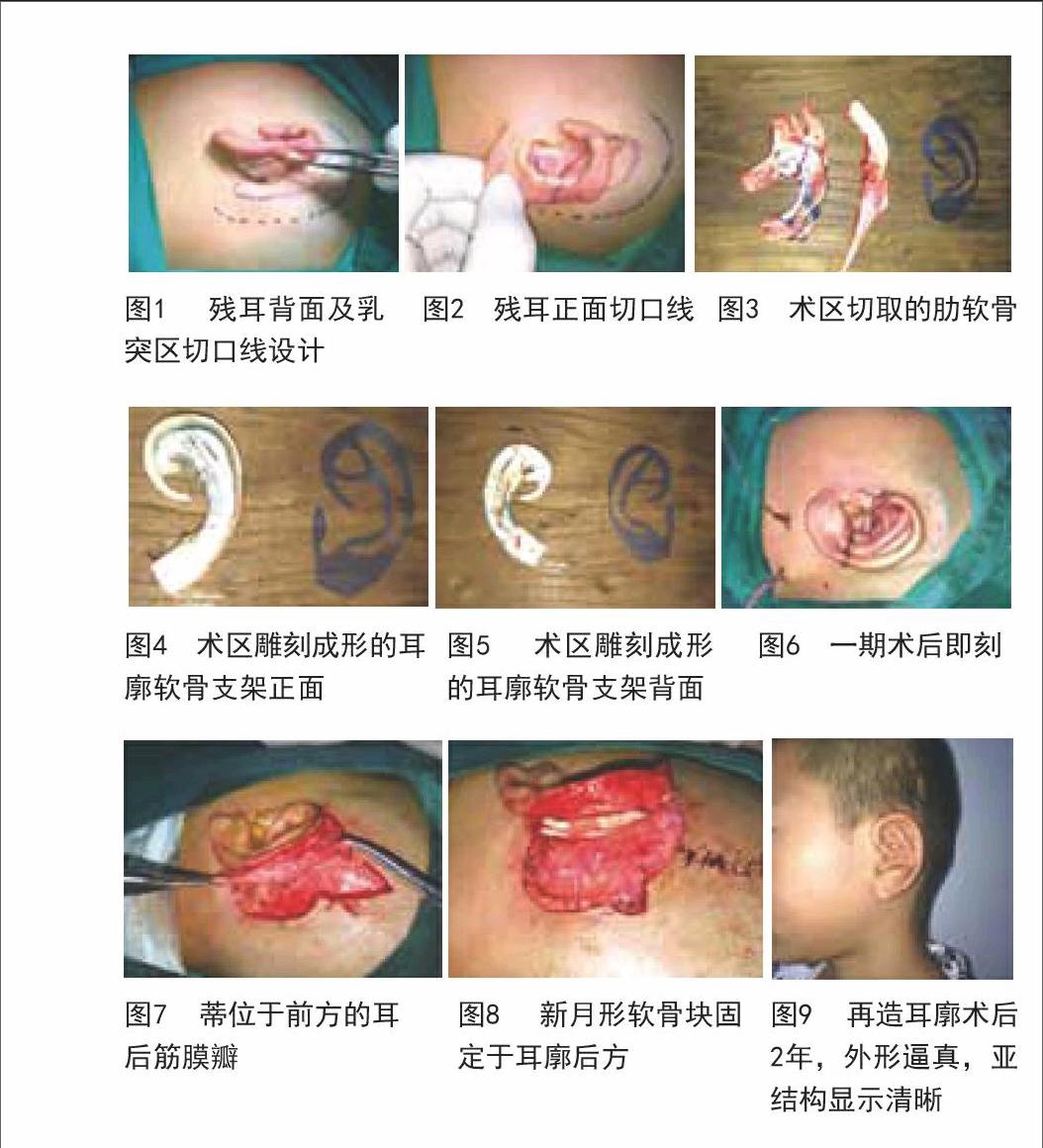 改良二期法耳廓再造術在耳甲腔型小耳畸形中的應用