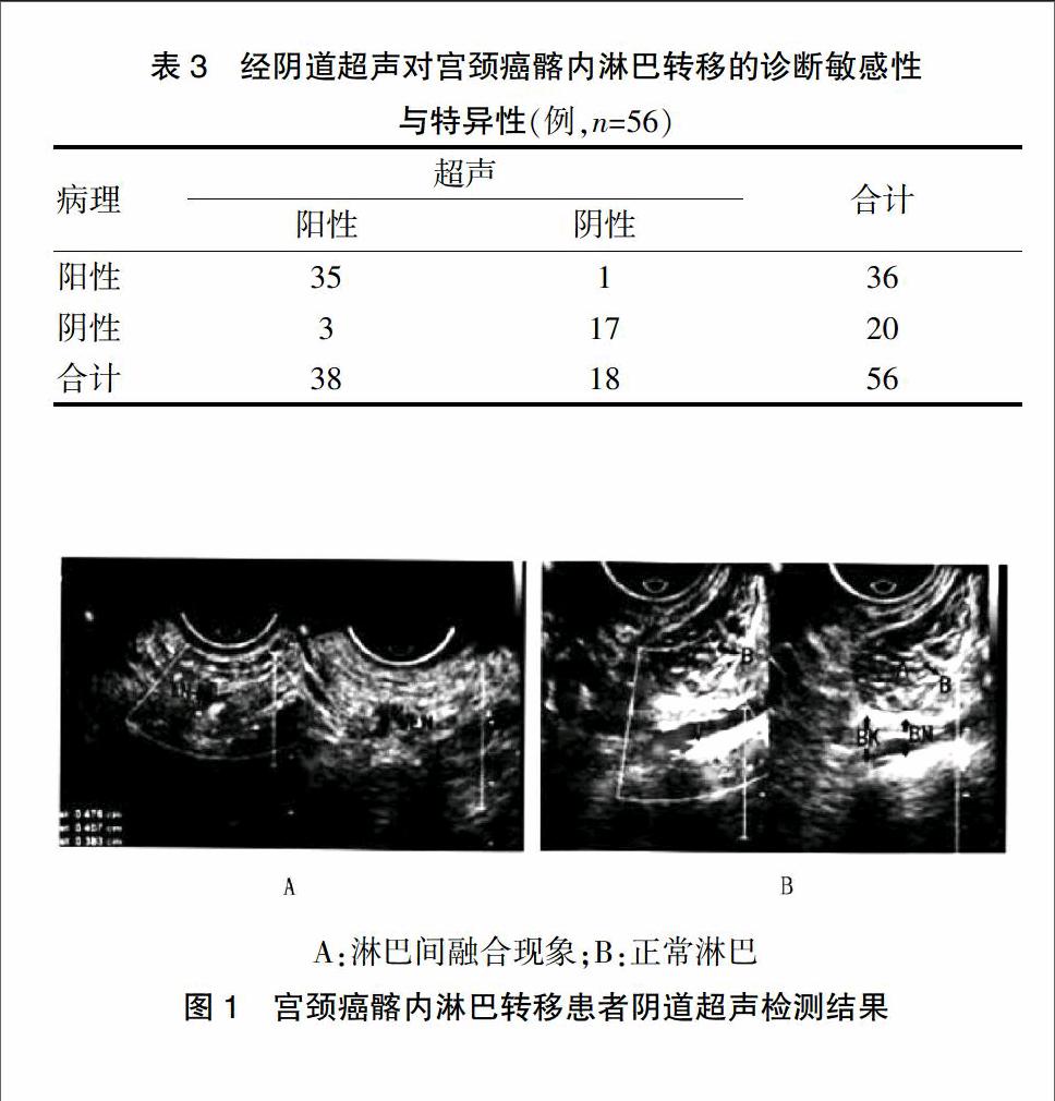 经阴道超声在宫颈癌髂内淋巴转移诊断中的价值