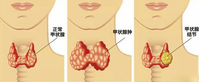 甲状腺长在颈部,传统手术会在颈部留下疤痕