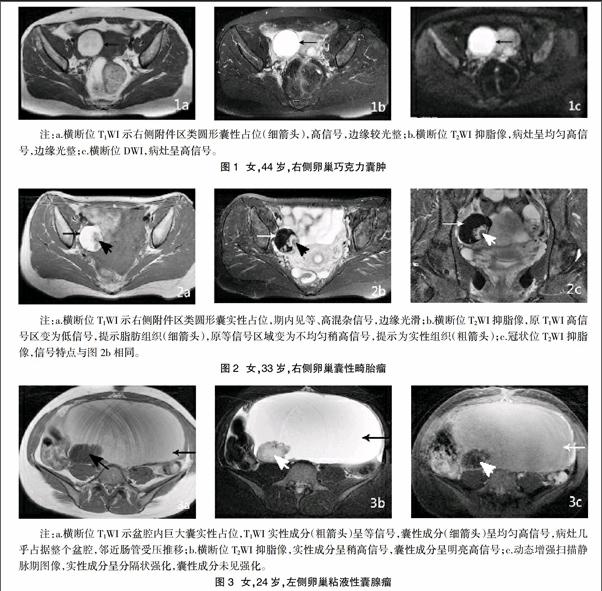 mri在女性盆腔囊性病變診斷中的應用價值分析