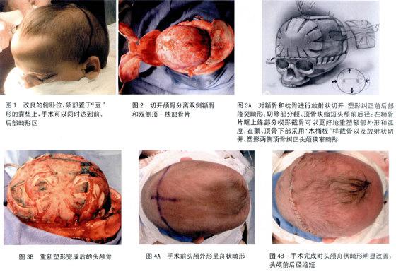 颅缝早闭手术图片图片