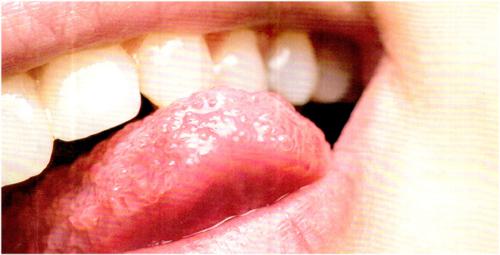 感染hpv舌头图片 病毒图片