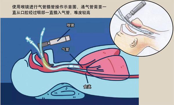 鼻子与气管的连接图图片