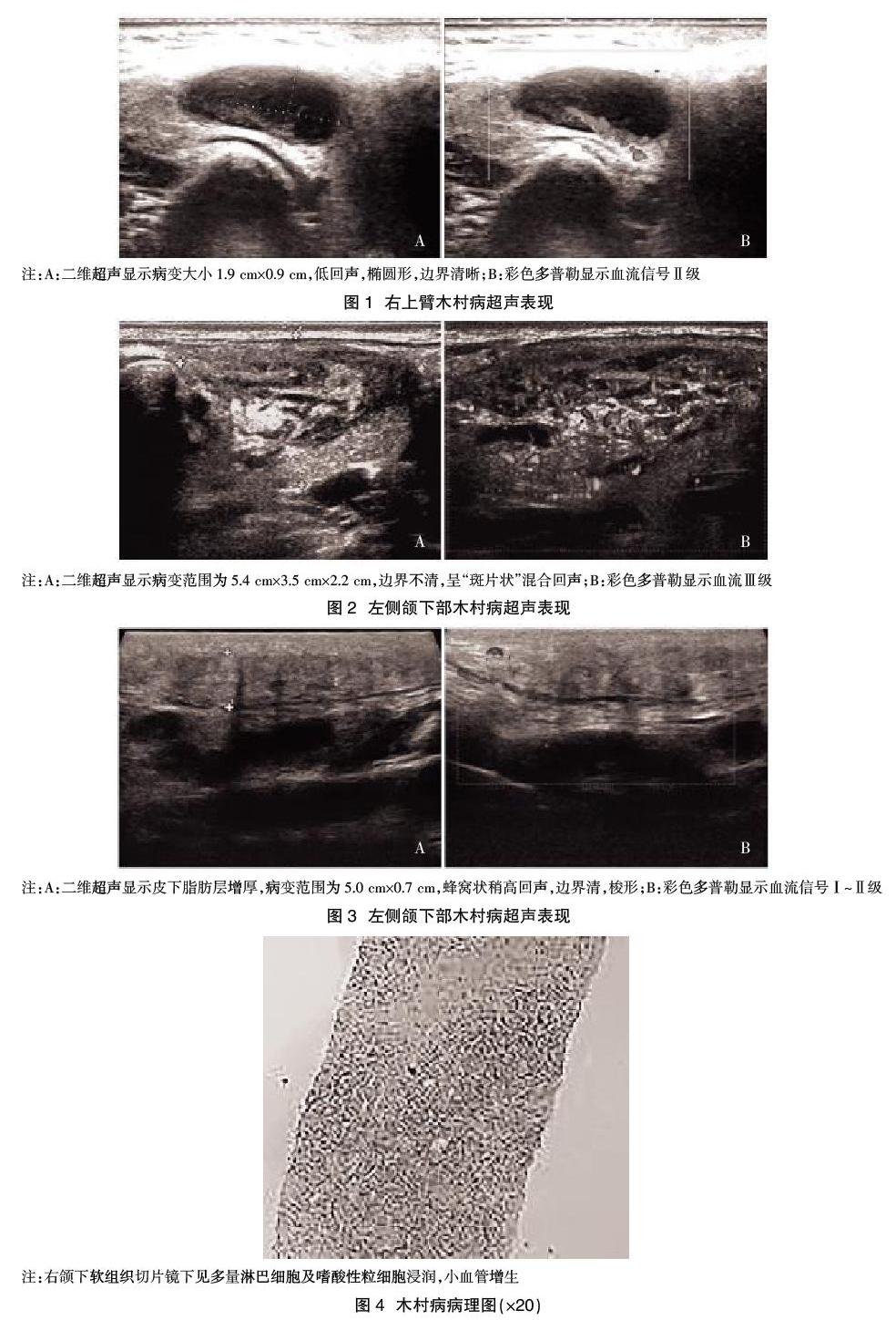 超声诊断木村病的临床价值_参考网