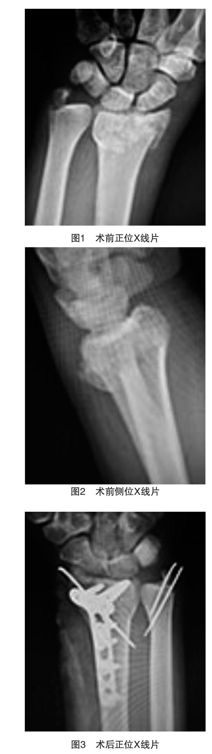 尺骨茎突基底部骨折的手术治疗对腕关节功能的影响 参考网