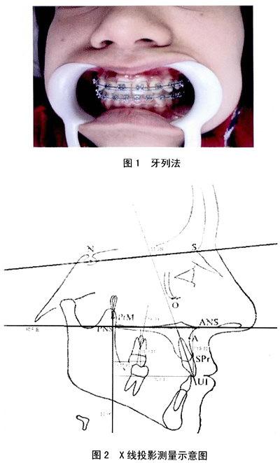 两种滑动法关闭拔牙间隙的比较研究