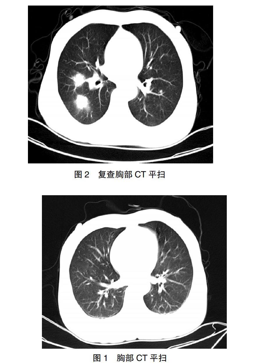 慢性肝衰竭併發肺部真菌感染1例並文獻複習